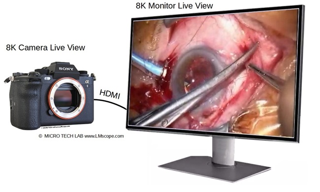 Live Video�bertragung zu einen externen Monitor, top Bildqualit�t,4K oder 8K, Zeiss OP-Mikroskop, Spaltlampe Zeiss OPMI Okulartubus mit 8K Monitor Kamera